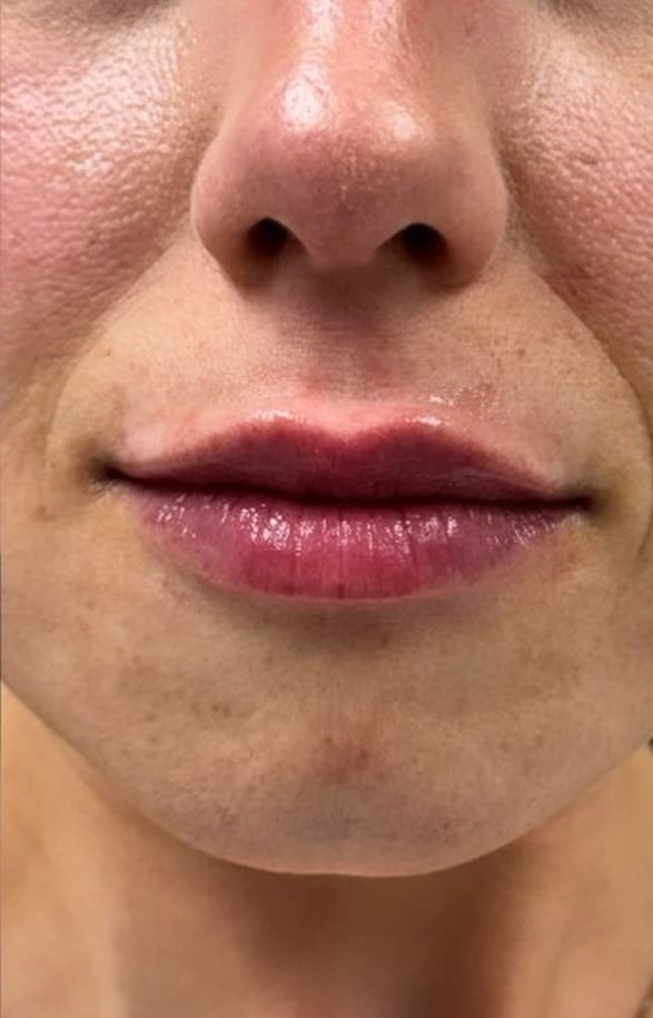 Lips before and after hyaluronic acid filler, front view