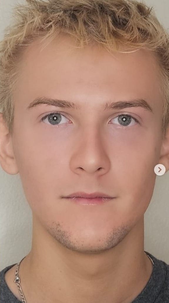 Male facial skin before and after treatment series