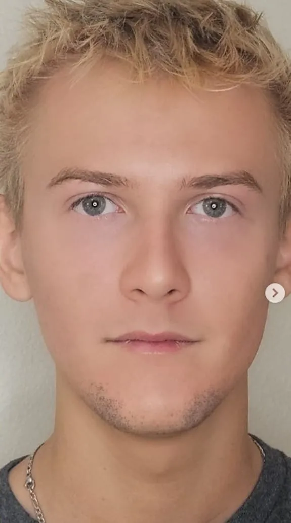 Male facial skin after treatment series