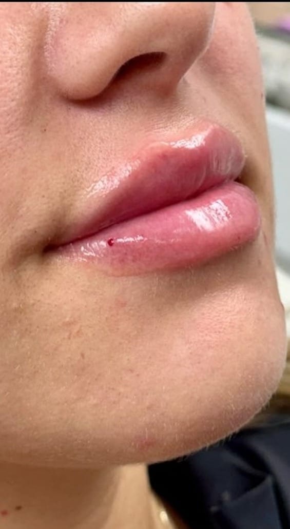 Lips before and after filler, oblique view