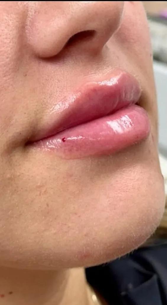 Lips after filler, oblique view