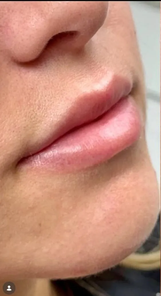 Lips before filler, oblique view