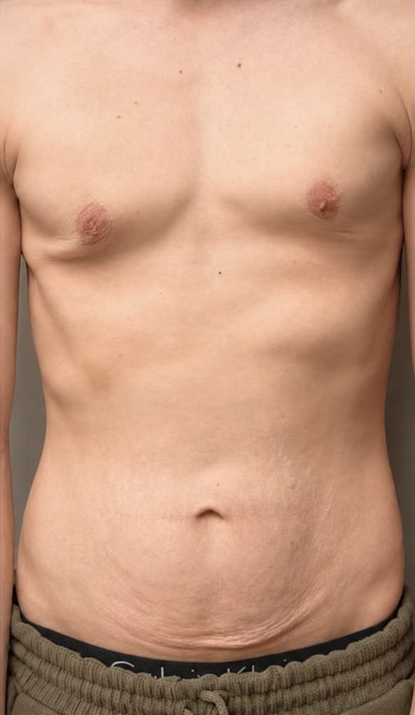 Male torso before and after body contouring series
