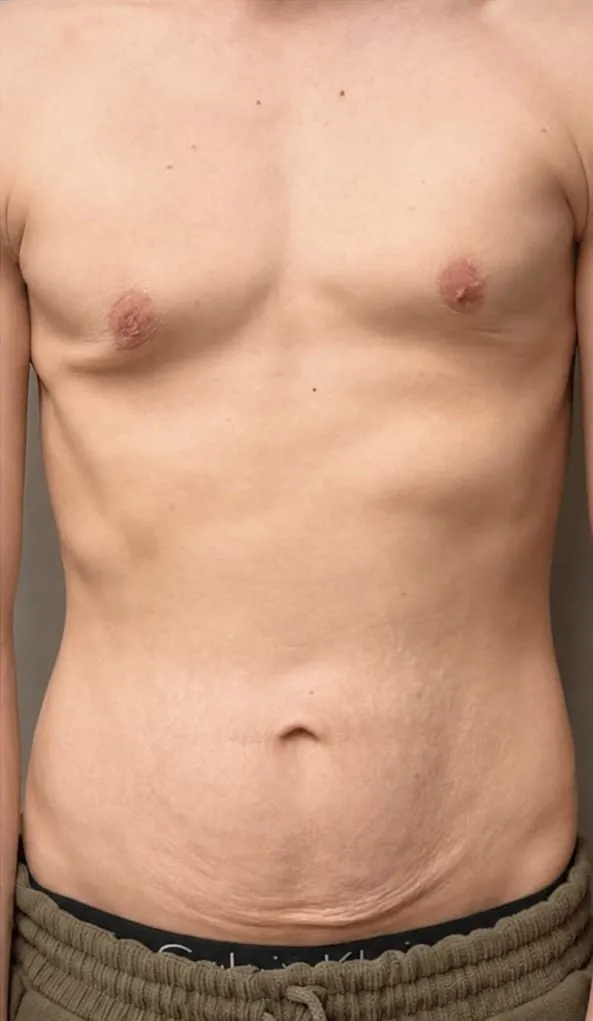 Male torso after body contouring series
