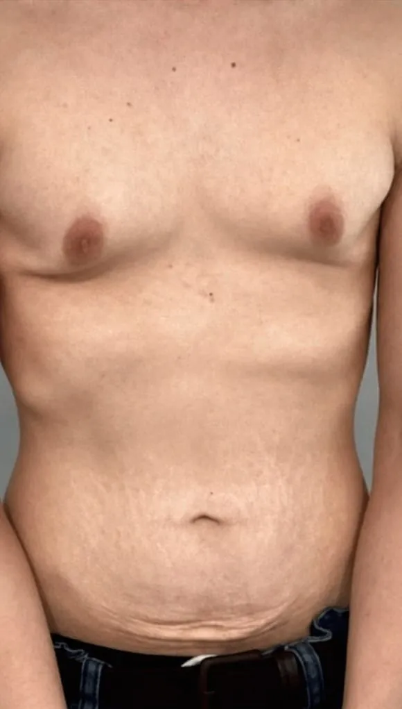 Male torso before body contouring series