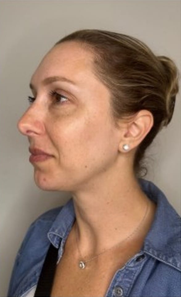 Side profile before and after facial balancing