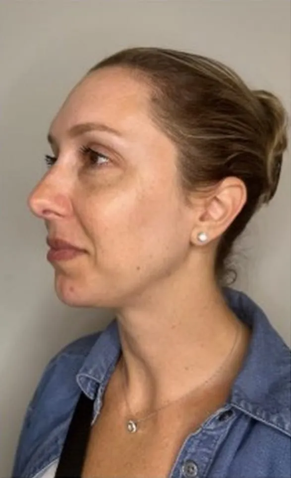 Side profile after facial balancing