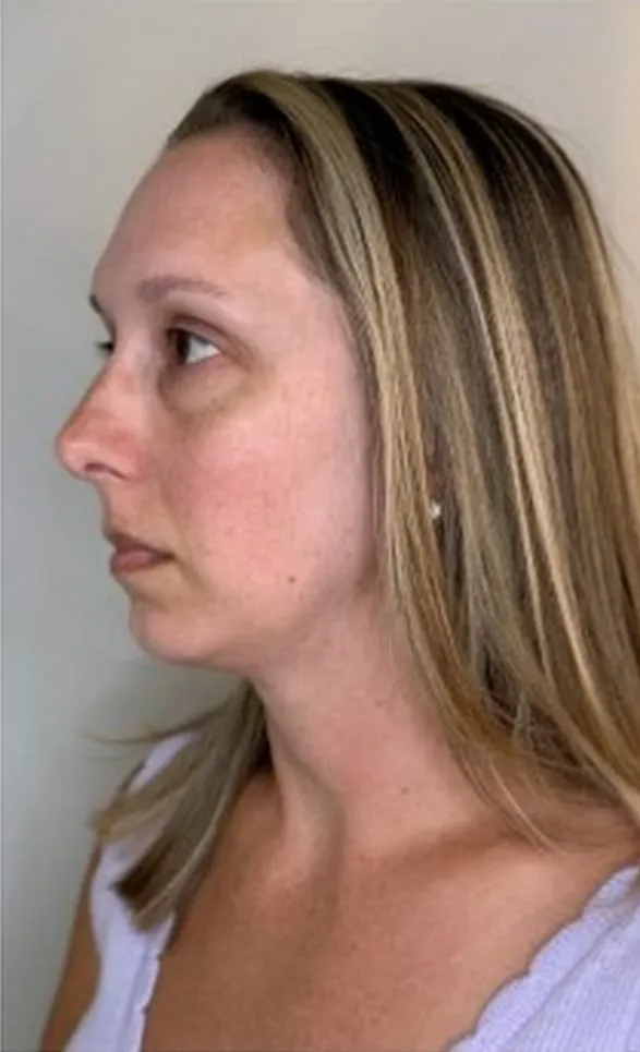 Side profile before facial balancing