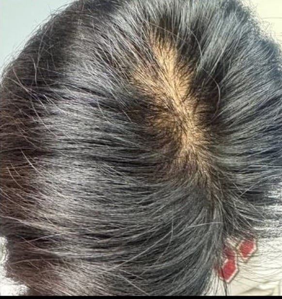 Scalp part line before and after hair restoration series