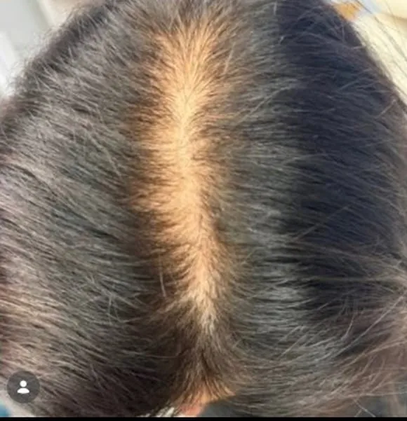 Scalp part line before and after hair restoration