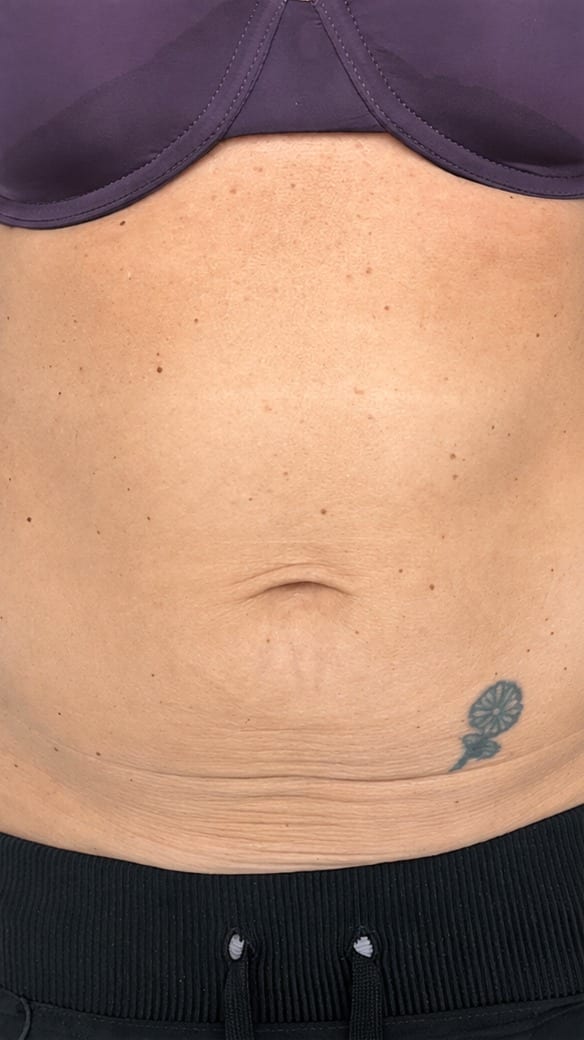 Abdomen before and after skin tightening series