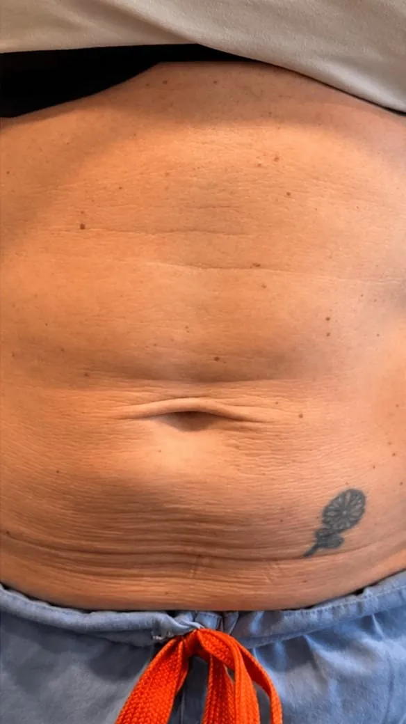 Abdomen before skin tightening series