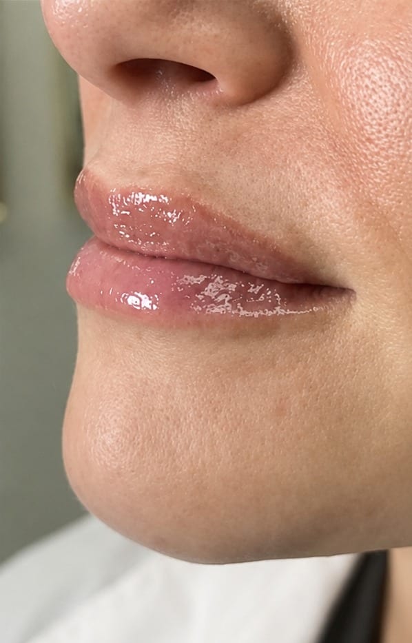 Lips before and after filler, oblique view