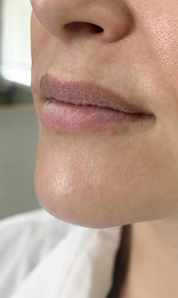 Lips before filler, oblique view