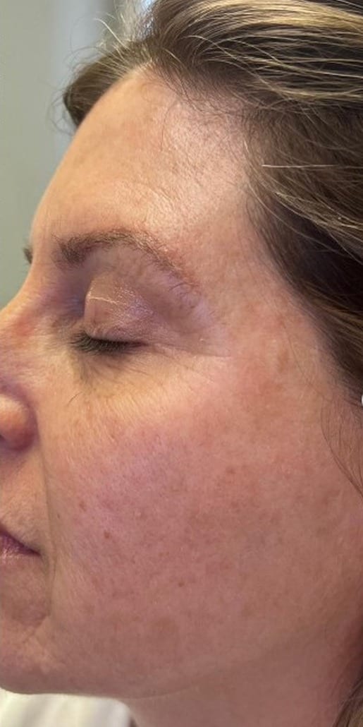 Facial pigment and texture before and after photofacial series