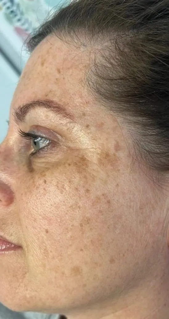 Facial pigment and texture before photofacial series