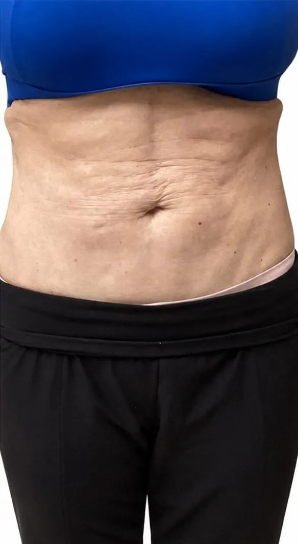 Abdomen before and after body contouring series