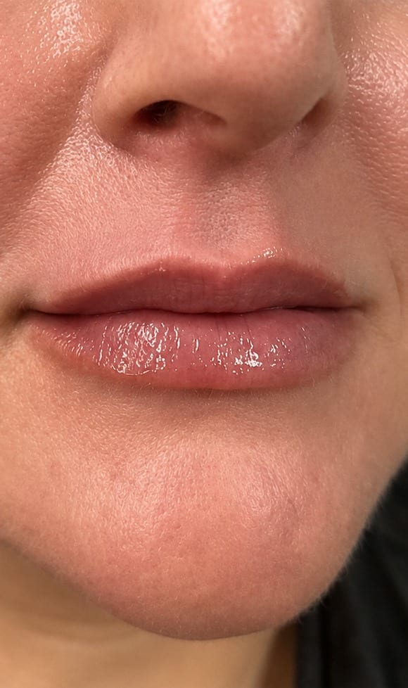 Lips before and after filler, front view