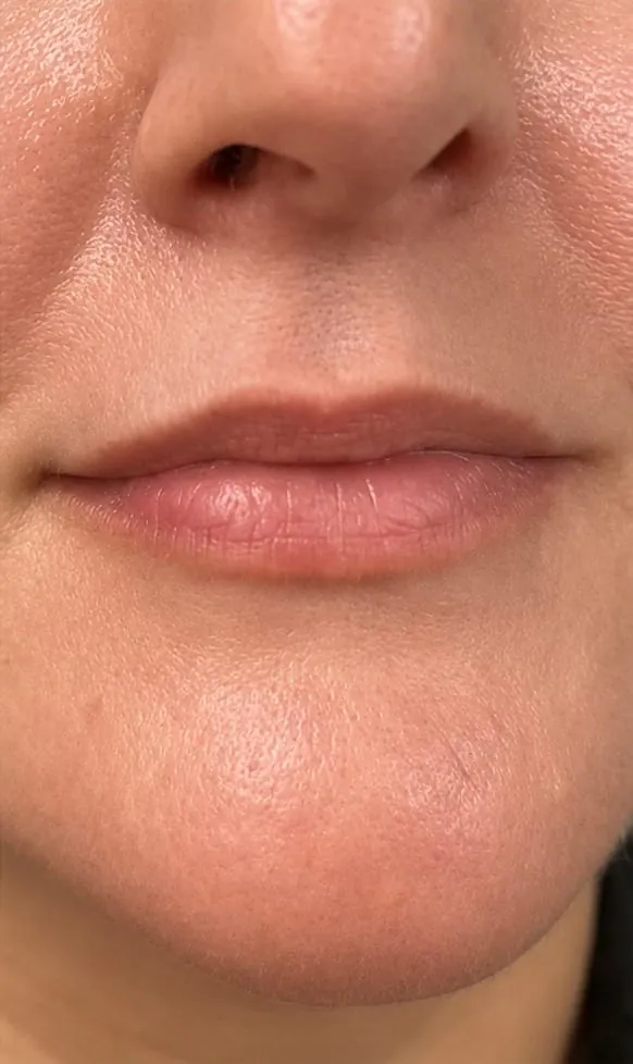 Lips before filler, front view