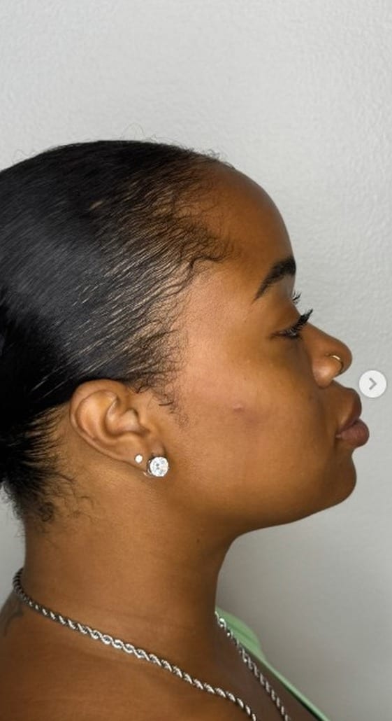 Profile before and after facial balancing filler