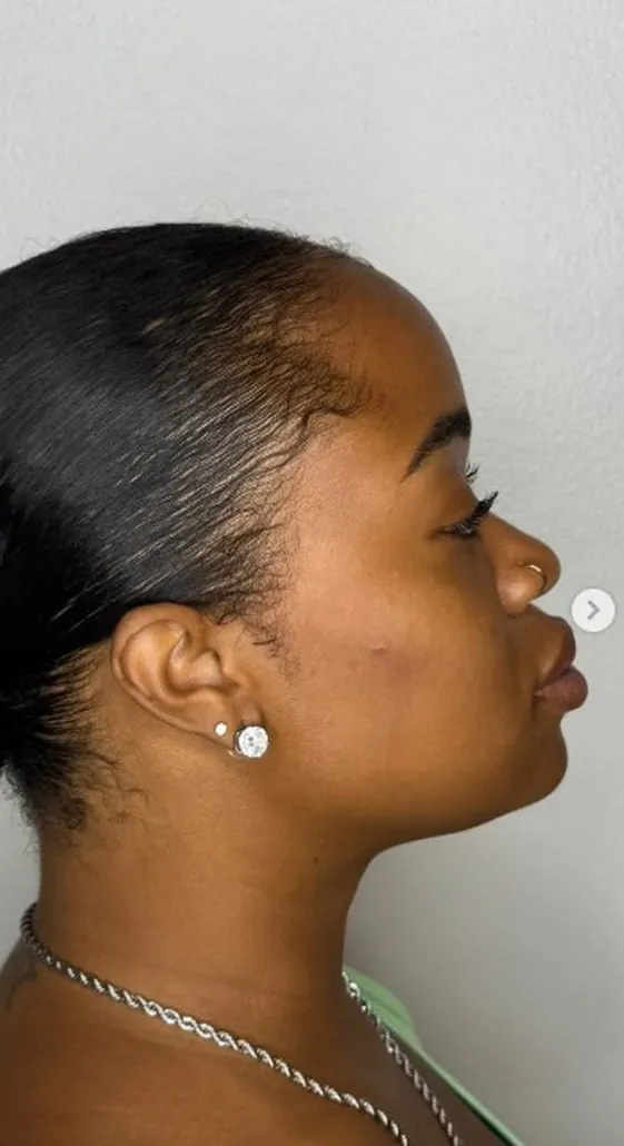 Profile after facial balancing filler