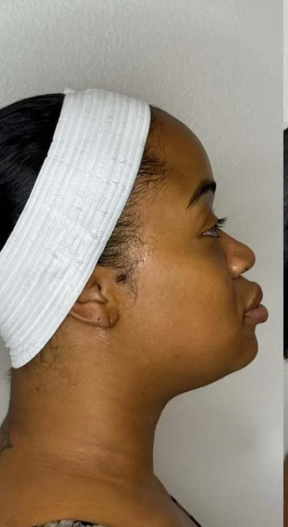 Profile before facial balancing filler