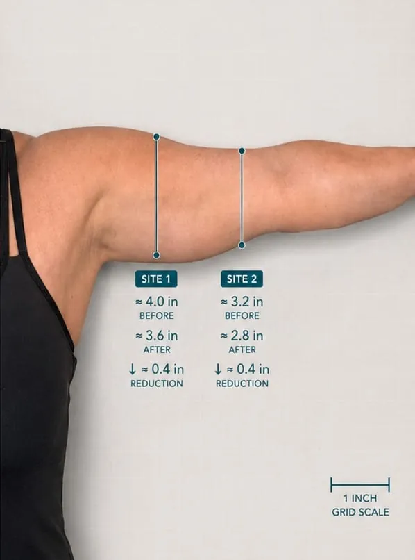 Upper arm before treatment with measured reduction