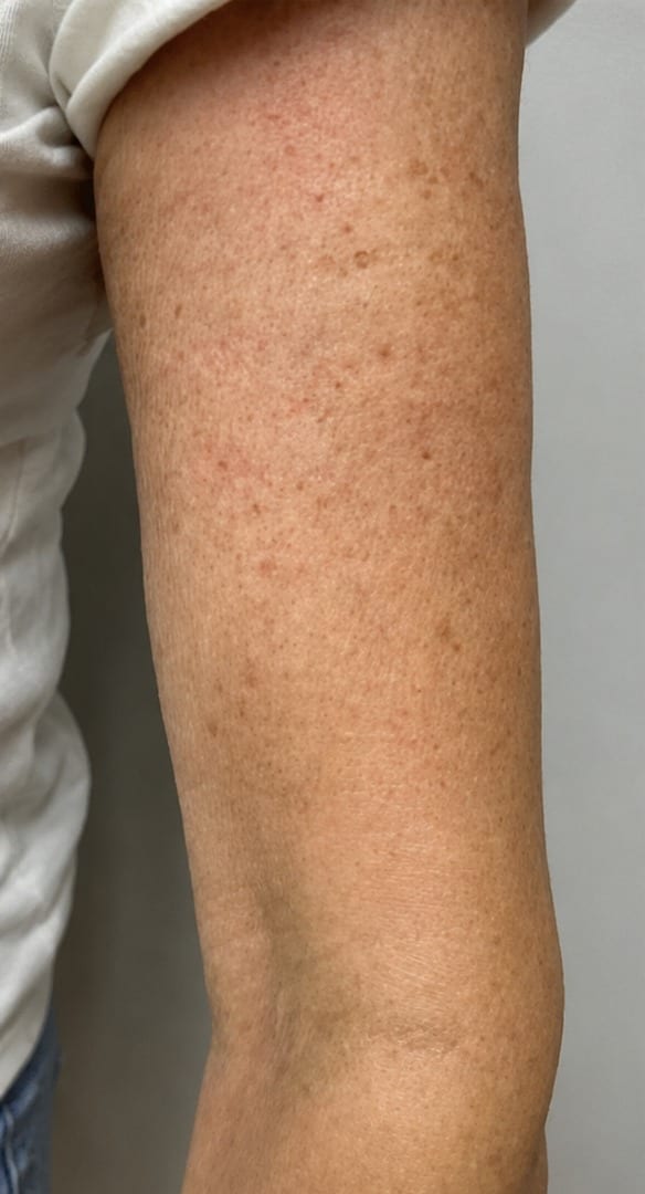Upper arm skin texture before and after treatment series