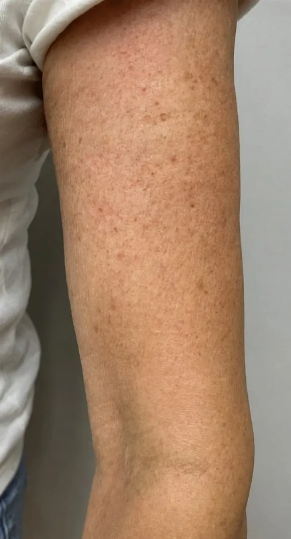 Upper arm skin texture after treatment series