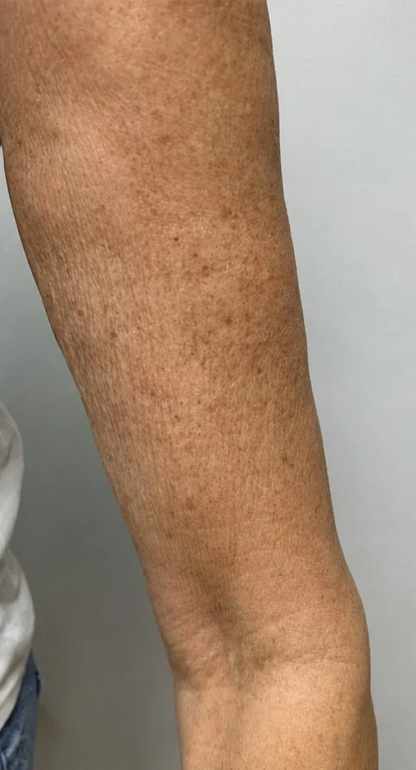 Upper arm skin texture before treatment series