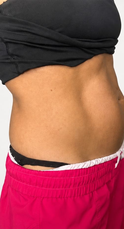 Abdomen before and after body contouring, side view