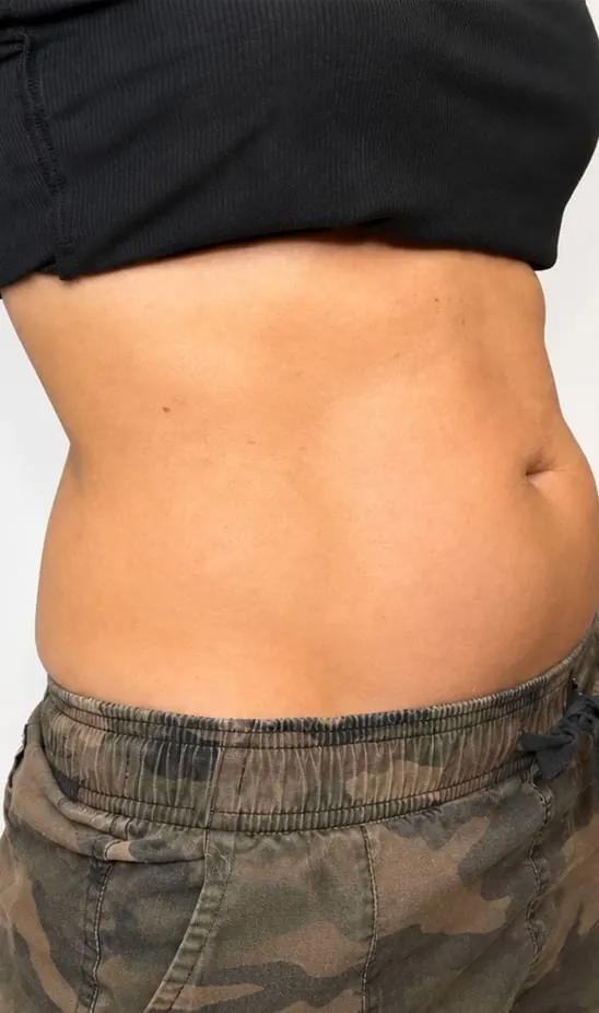 Abdomen before body contouring, side view