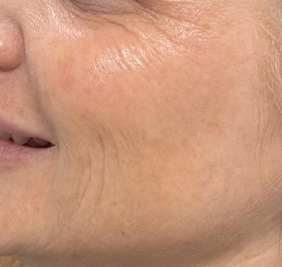 Cheek and crow's-feet area before and after Skinvive treatment