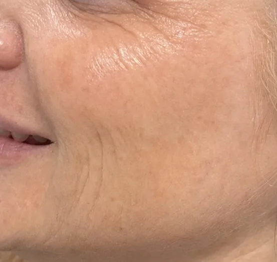 Cheek and crow's-feet area after Skinvive treatment