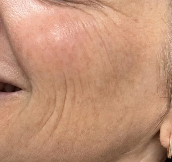 Cheek and crow's-feet area before Skinvive treatment