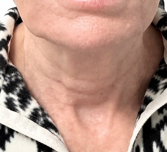 Neck before and after skin tightening series