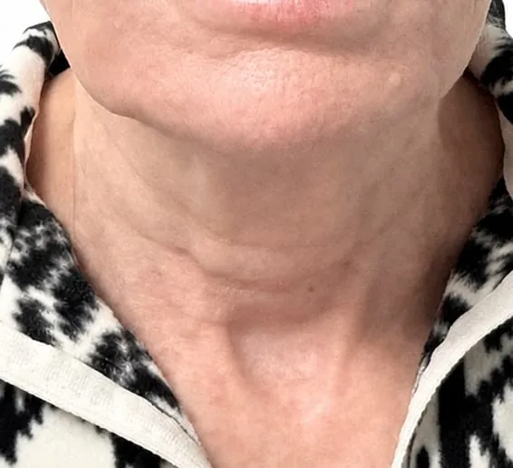 Neck after skin tightening series