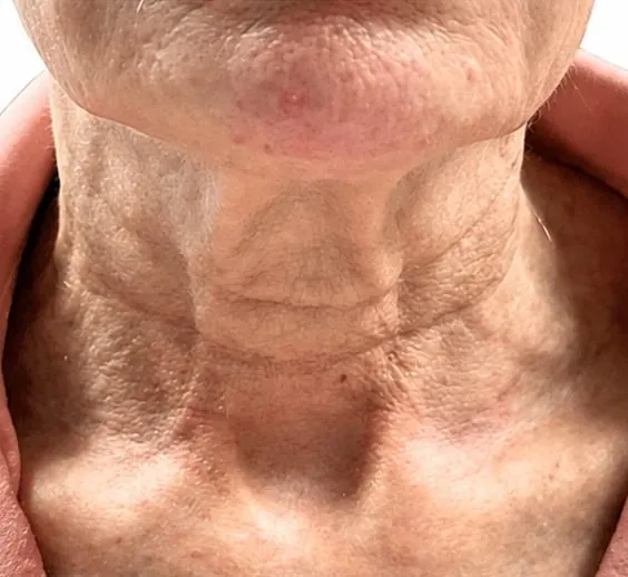 Neck before skin tightening series
