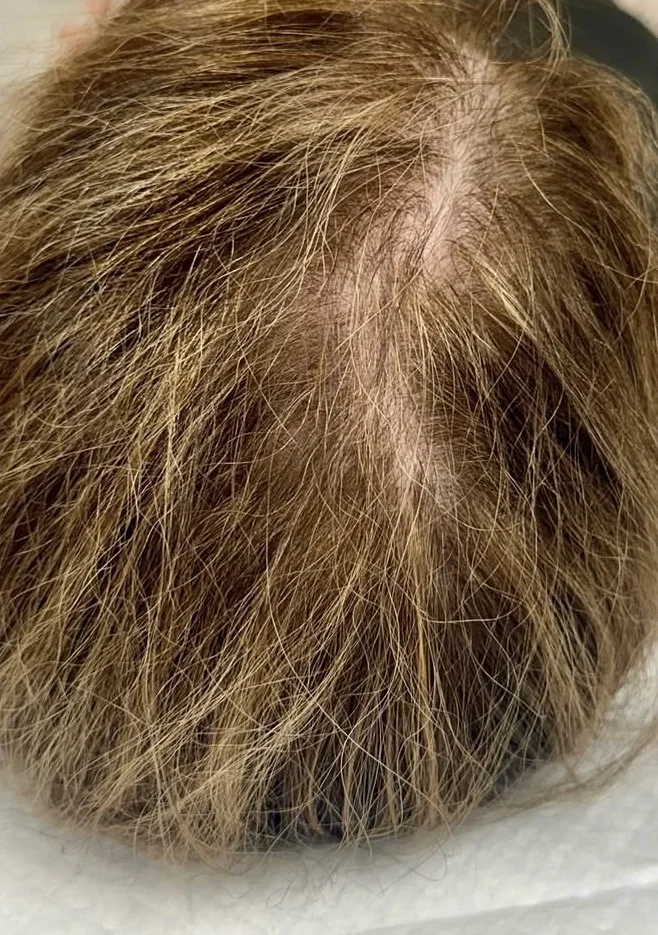 Scalp part line after microneedling with PDGF for hair restoration