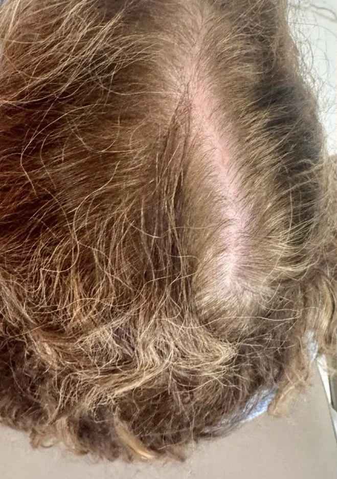 Scalp part line before microneedling with PDGF for hair restoration