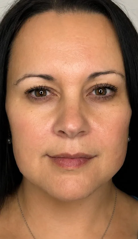 Full face after neuromodulator treatment