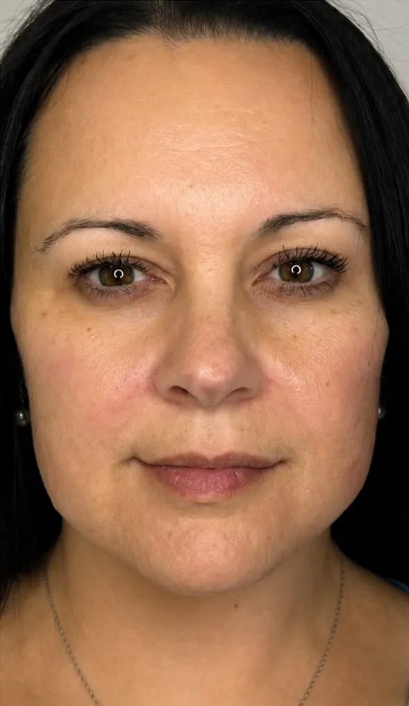 Full face before neuromodulator treatment