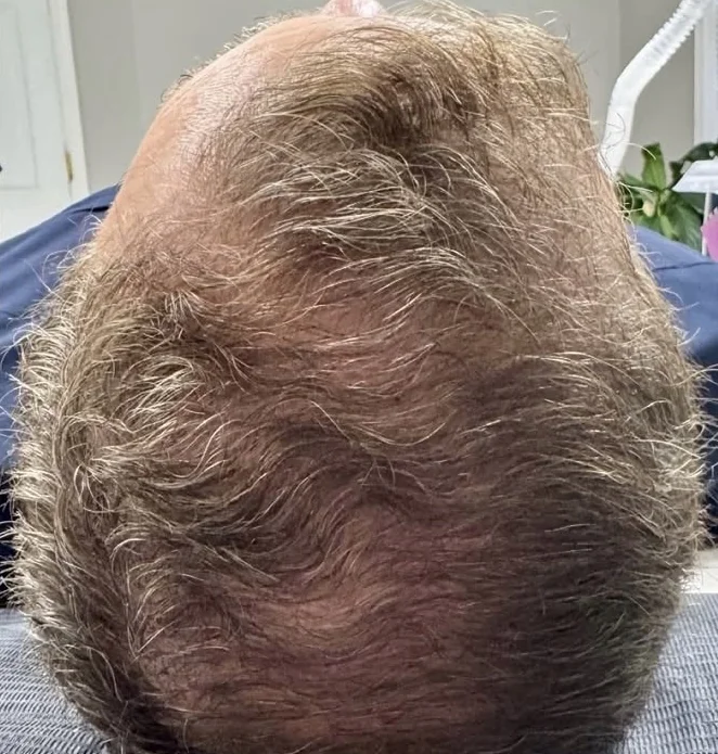 Crown of the scalp after microneedling with PDGF for hair restoration
