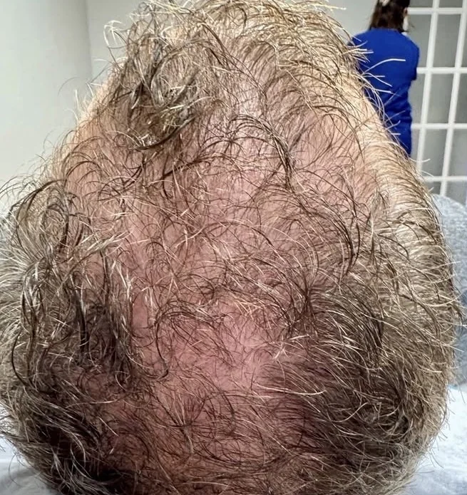 Crown of the scalp before microneedling with PDGF for hair restoration