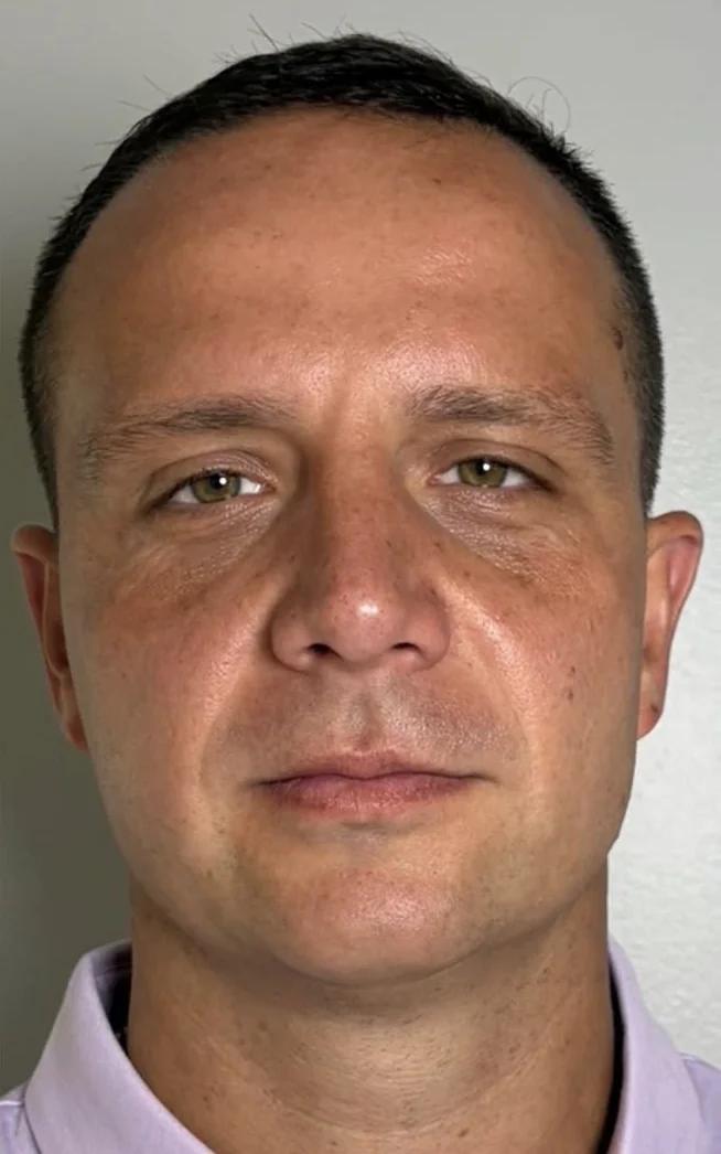 Male face, front view, after a PRX topical biostimulator series