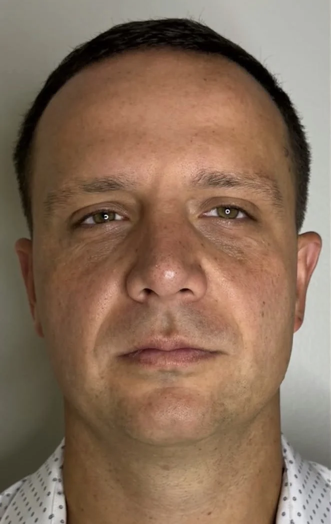 Male face, front view, before a PRX topical biostimulator series