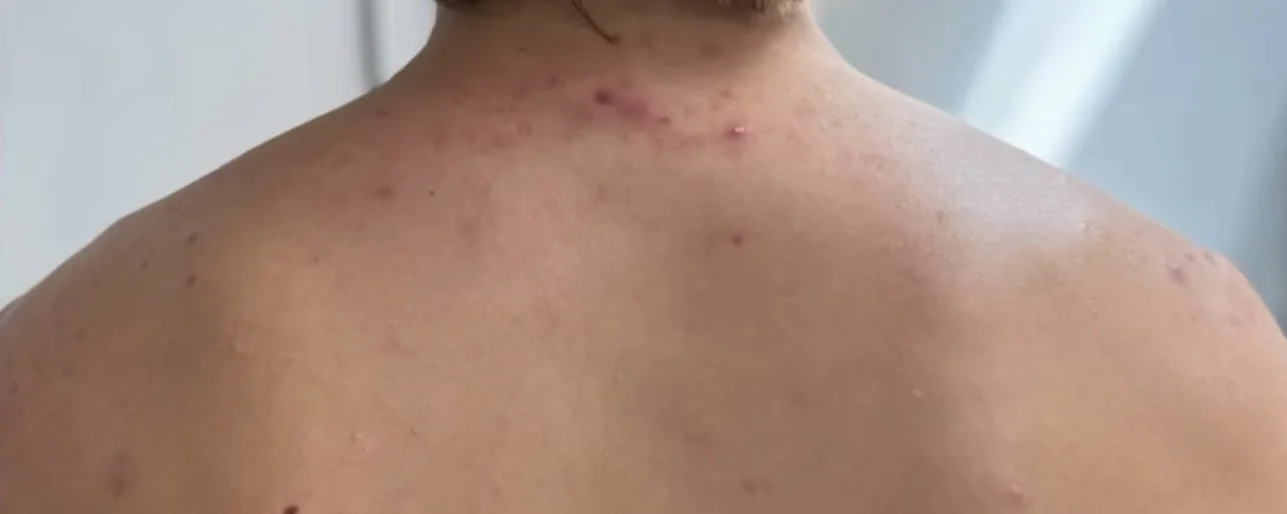 Upper back and shoulders after a BioRePeel body series for acne