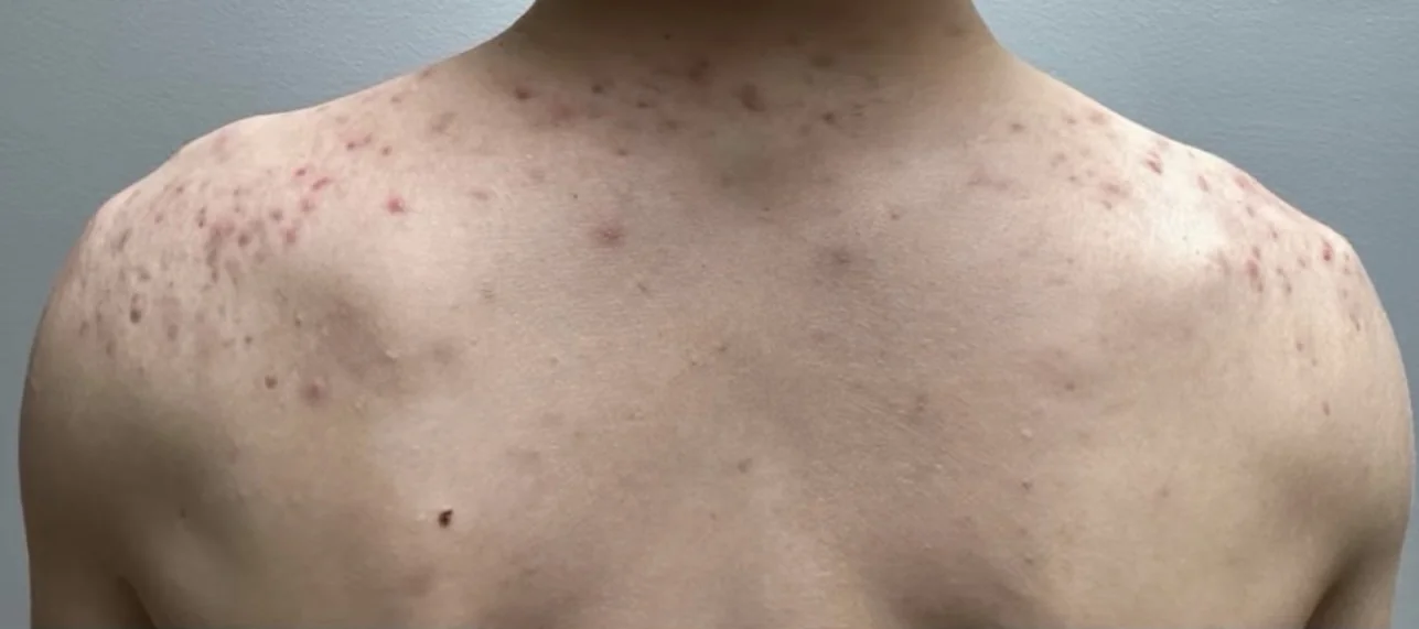 Upper back and shoulders before a BioRePeel body series for acne