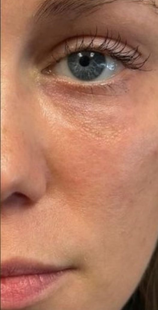 Under-eye area before and after filler