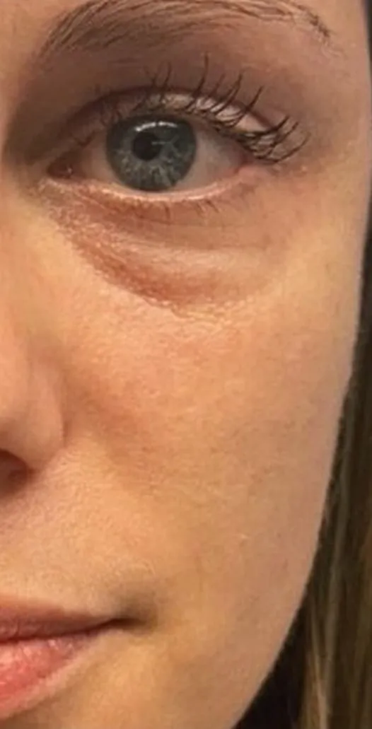 Under-eye area before filler